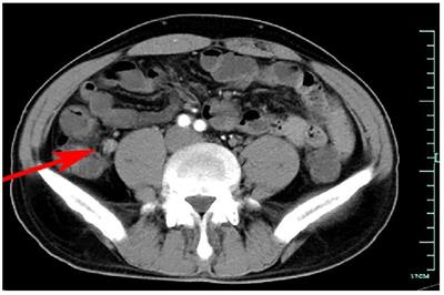 Endoscopic retrograde appendicitis therapy in the management of chronic fecalith appendicitis in a patient with ulcerative colitis: The first human case report